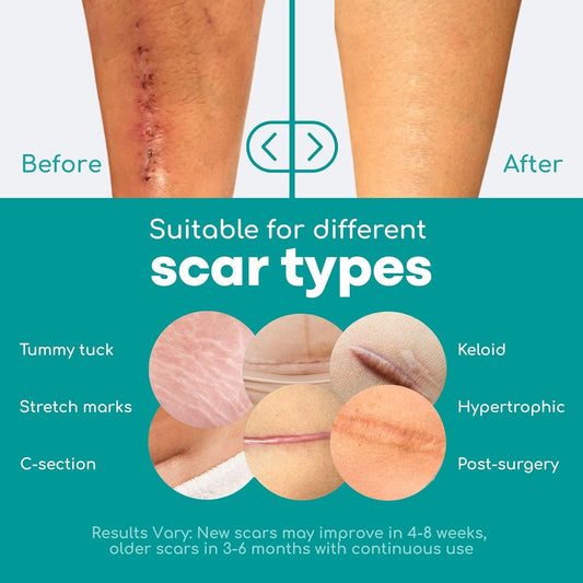 Medi Grade Silicone Scar Tape, 2 Metres With Hygienic Case - Reusable, Eco Friendly Scar Sheets For C-Section Recovery Or Keloid Bump Treatment - Long Lasting Silicone Tape For Scars