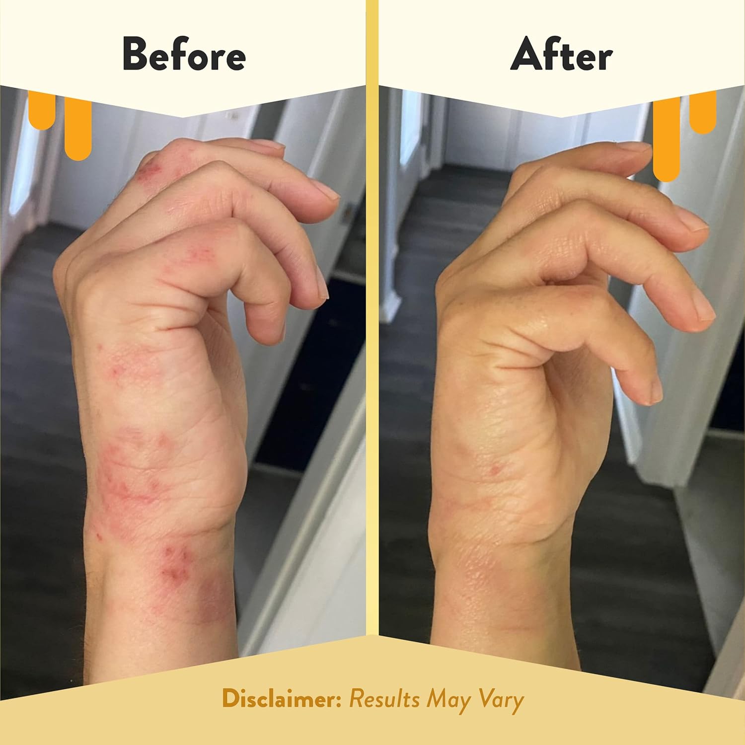 Eczema Honey Antioxidant Body Oil - After Shower All Over Body Oil Spray For Skin - Eczema-Prone & Sensitive Moisturizing Skin Oil - Unscented Body Oils For Women, Men & Kids (8 Fl Oz) : Beauty & Personal Care