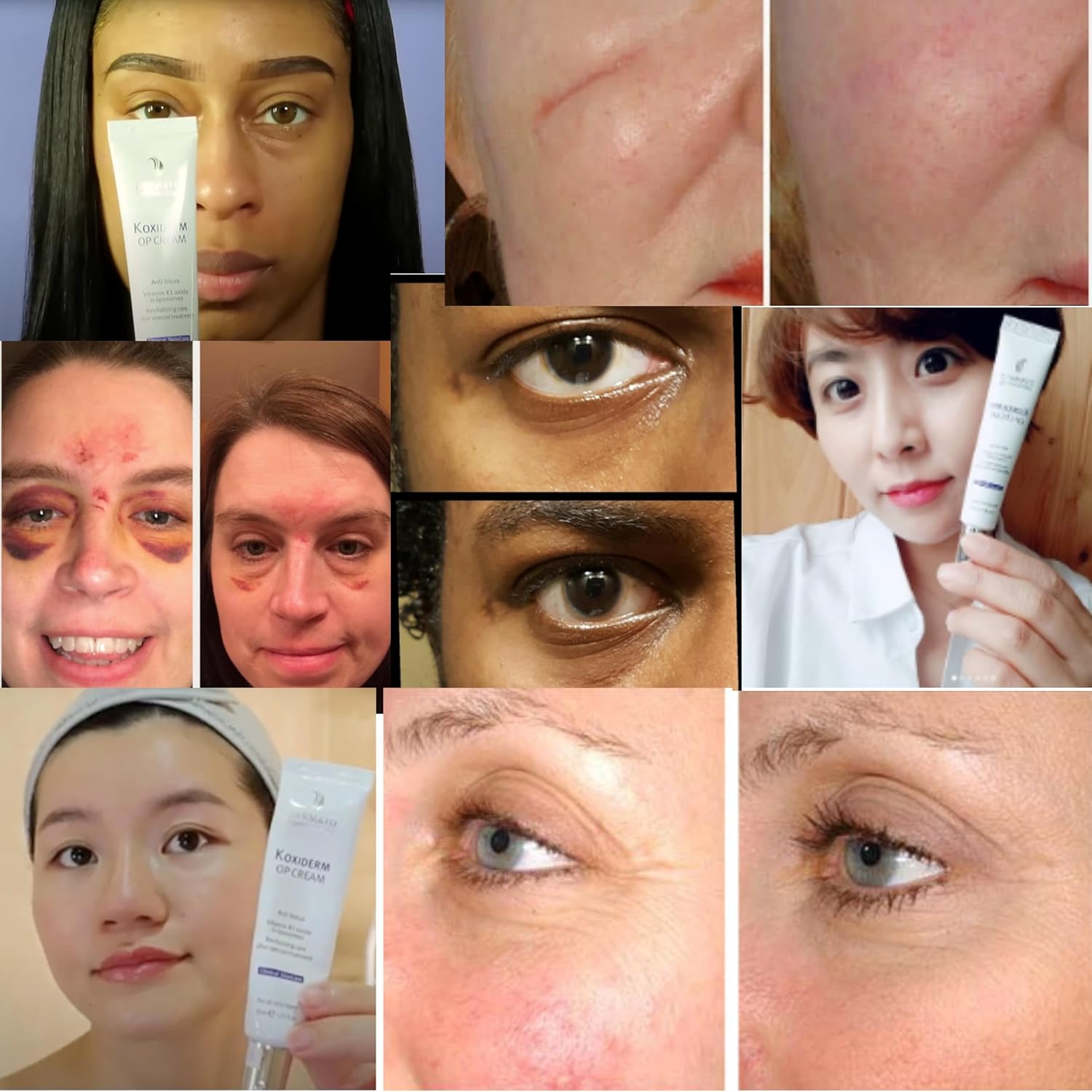 Anacis Vitamin K1 Oxiderm Cream Minimizing Appearance Of Old And New Scars, Dark Eye Circles, Bruises, Varicose Veins, Purpura And Redness 1.01Oz : Beauty & Personal Care