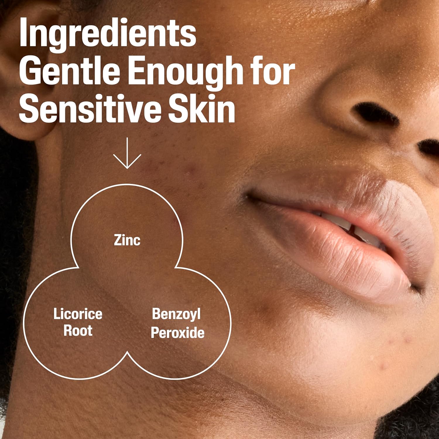Cetaphil Gentle Clear Complexion-Clearing Bpo Acne Cleanser With 2.6% Benzoyl Peroxide, Creamy And Soothing For Sensitive Skin, Suitable For All Skin Types, 4.2Oz : Beauty & Personal Care