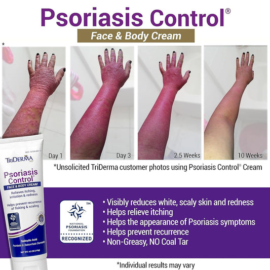 Triderma Psoriasis Control Face And Body Cream, 4.2 Ounces