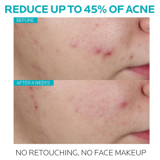 La Roche-Posay Effaclar Salicylic Acid Acne Treatment To Minimize Pores, Clear Acne Blemishes And Post Acne Marks