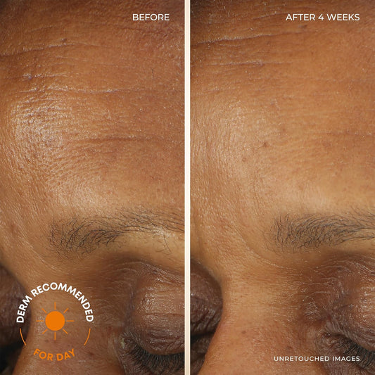 Roc Retinol Correxion Deep Wrinkle Facial Moisturizer Skin Care Bundle: Retinol Correxion Deep Wrinkle Night Cream + Deep Wrinkle Day Cream With Spf 30