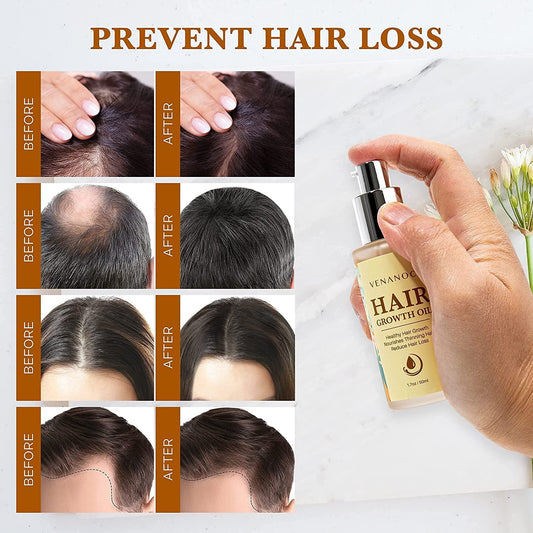 Biotin & Castor oil & Rosemary Oil for Hair Growth for Women, hair loss treatments for dry damaged hair and growth, Serum for Thicker Longer Fuller Healthier Hair, All Natural Vitamin Rich Treatment