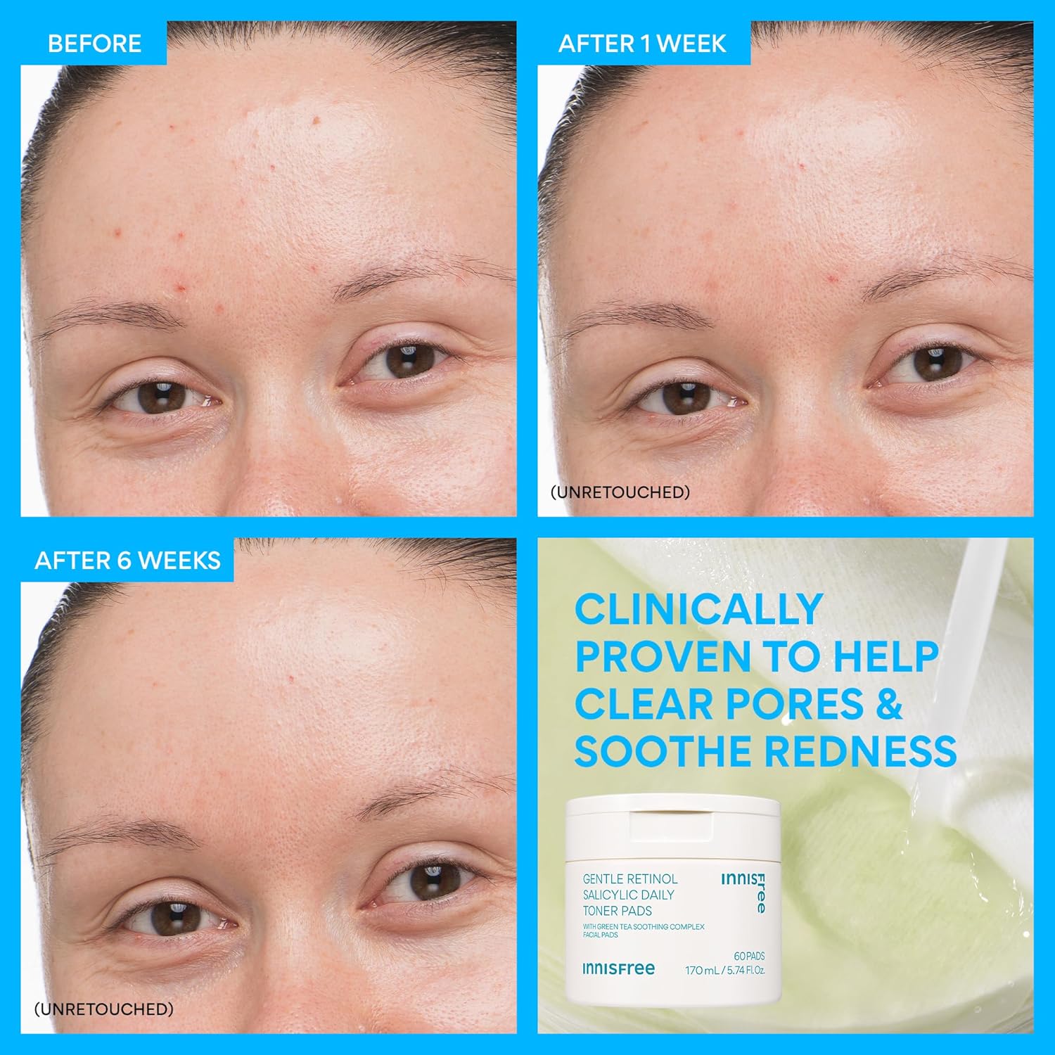 Innisfree Daily Gentle Retinol Salicylic Toner Pads, Korean Sheet Mask Pads For Acne-Prone Skin Care : Beauty & Personal Care