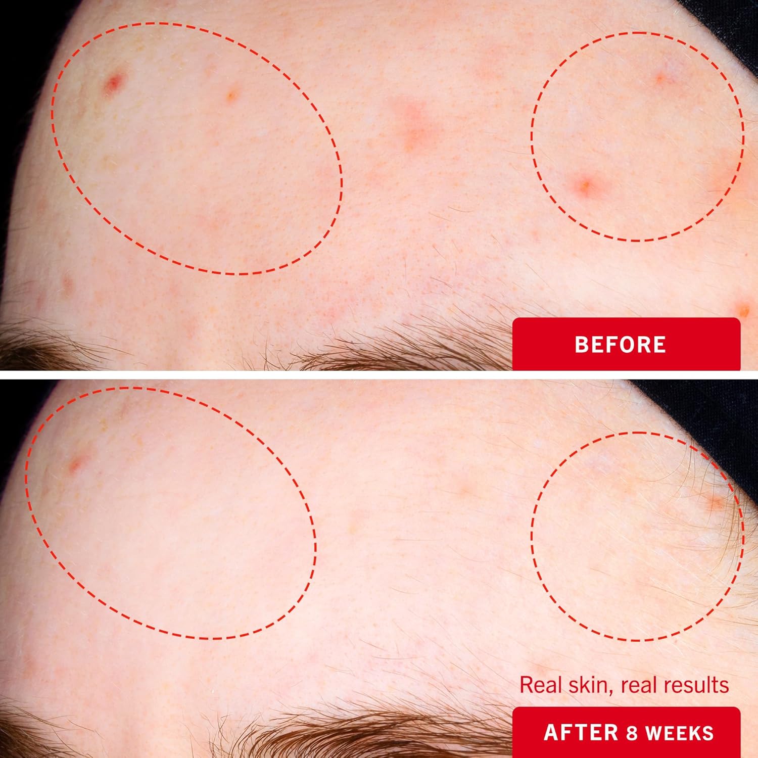 First Aid Beauty Lactic Acid Lotion For Acne-Prone Skin With 2% Niacinamide - Resurfacing Lotion Moisturizes & Visibly Diminishes Post-Acne Marks, (1.0 Oz) : Beauty & Personal Care