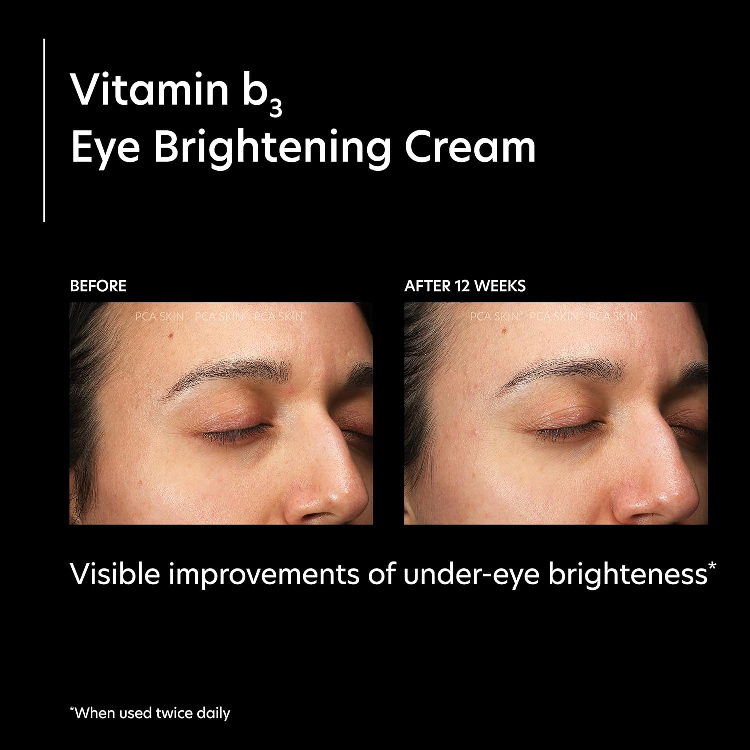PCA SKIN Vitamin B3 Eye Brightening Cream, Eye Brightener For Bright Eyes, Dark Circles, Wrinkles, and Uneven Skin Tones, Anti Aging Eye Cream, Formulated with Niacinamide, 1 oz Tube : Beauty & Personal Care