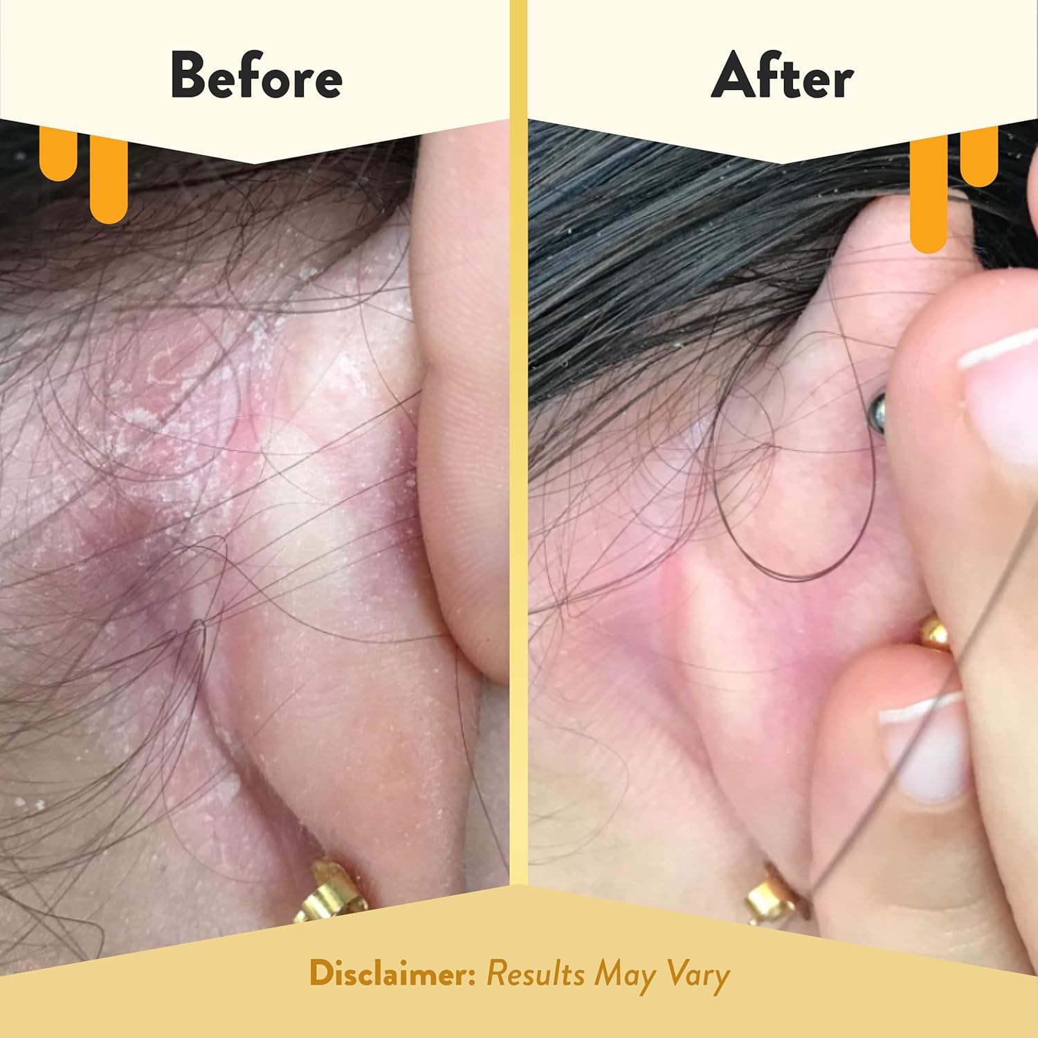 Eczema Honey Gentle Face & Body Lotion Stick - Moisturizing Colloidal Oatmeal Hand Cream For Extremely Dry Skin - Eczema Lotion Helps Psoriasis, Dermatitis & More (2.2 Oz) : Beauty & Personal Care