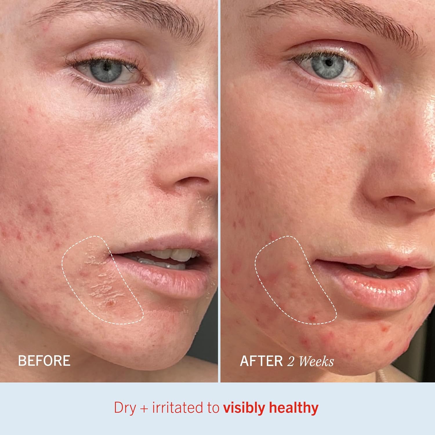 First Aid Beauty Ultra Repair Cream Intensive Hydration Daily Moisturiser For Face + Body – Strengthens Skin Barrier + Instantly Relieves Dry, Distressed Skin – 170.1 G + Bonus 28.3 G Travel Size