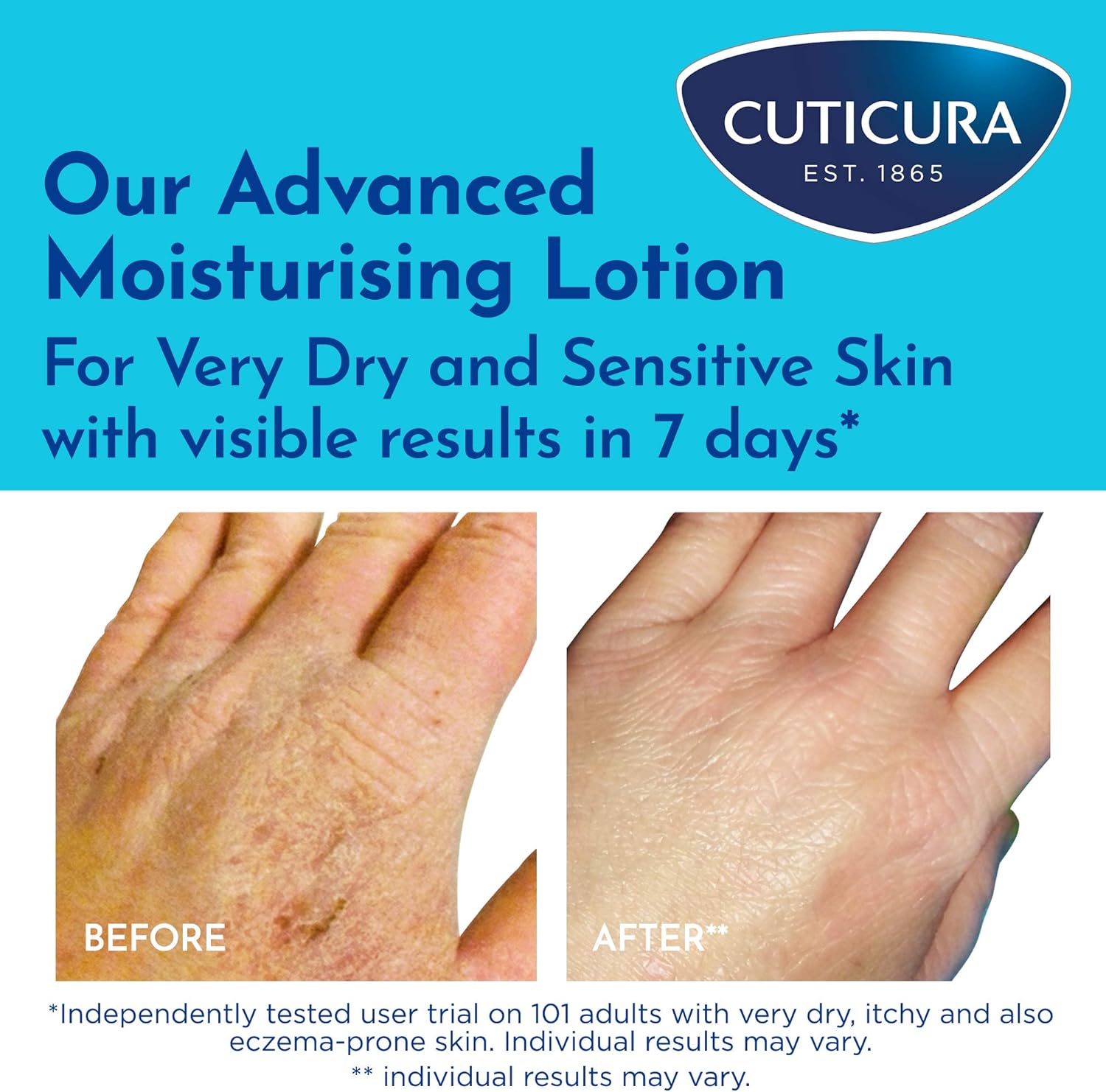 Cuticura Mildly Medicated Dry Skin Cream ml Advanced Moisturising Lotion For Very Dry and Sensitive Skin Suitable For Hands Feet and Body, Aloe Vera, 200 millilitre : Amazon.co.uk: Beauty