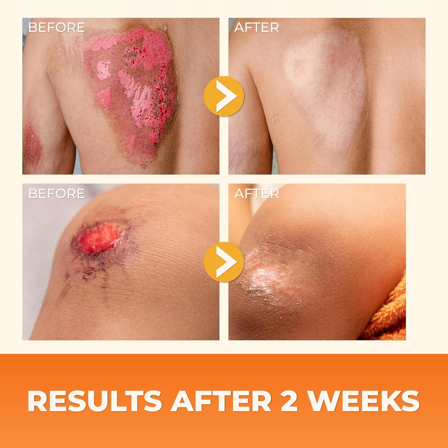 Abera Red Turmeric Scar Removal Cream (Premium Product) - Advanced Treatment For Face And Body With Natural Ingredients Scar Rapidly Removes Stretch Marks, Keloids, Burns, And More