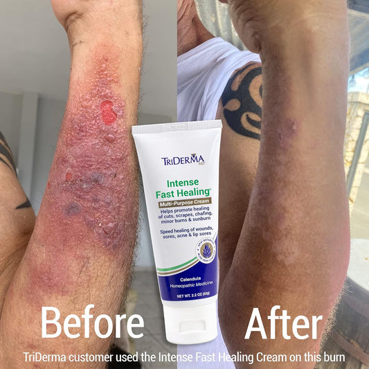 Triderma Intense Fast Skin Healing Cream For Hard-To-Heal Skin Irritations, Sores, Rashes, Dry, Cracked Hands, Cuts, Chafing, Burns, Scrapes - First Aid Kit Essential - Fsa Eligible - 2.2 Oz Tube