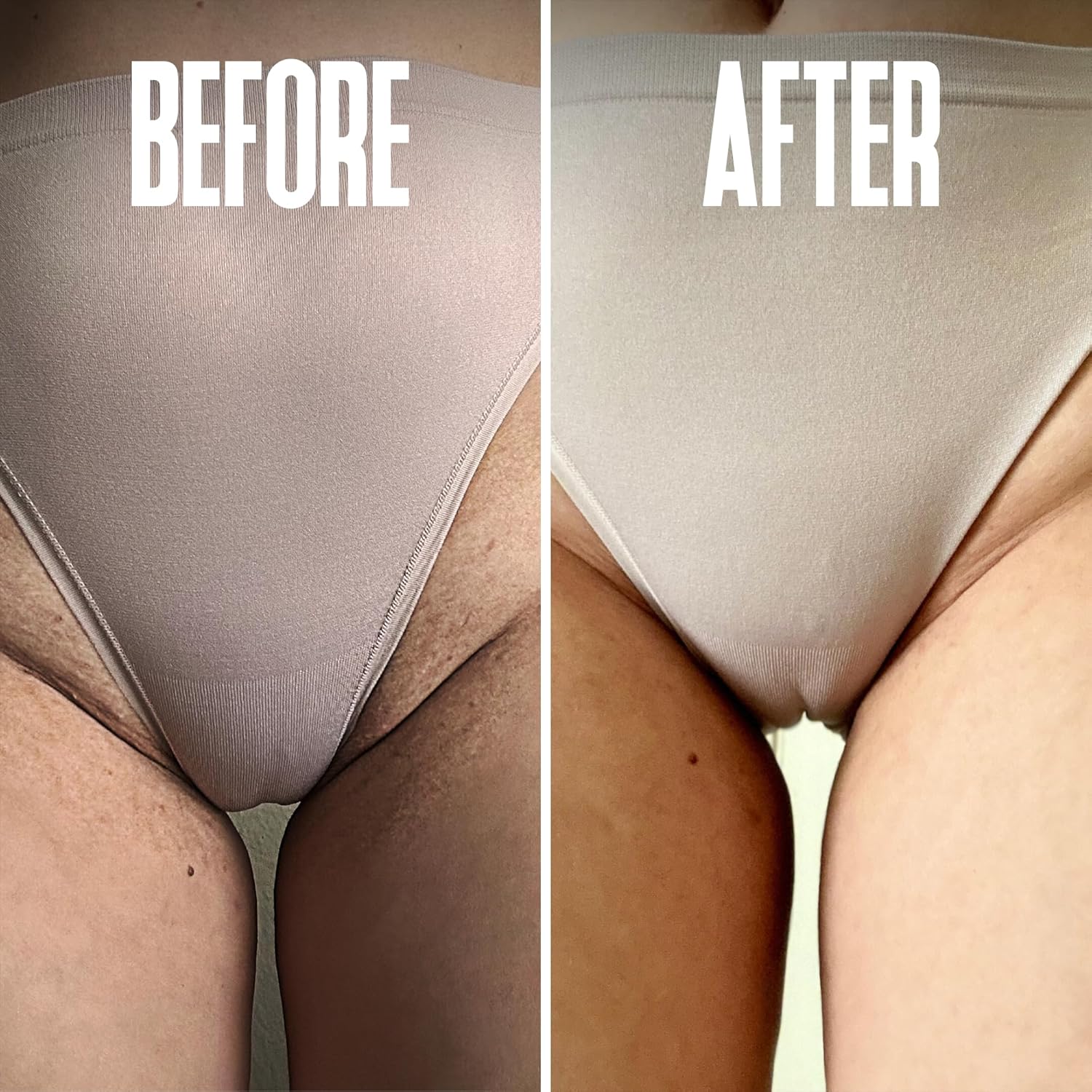 Prevent Ingrown Hairs And Razor Bumps With Bha & Aha Pads - Ingrown Hair Serum For Razor Burns - Pfb Razor Bump Stopper Topicals Skin Care, Ingrown Hair Treatment For Bikini Area And Razor Bumps : Beauty & Personal Care