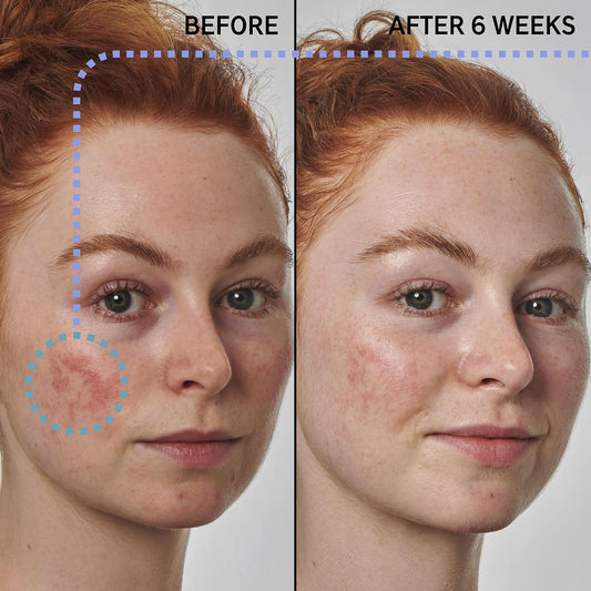 The Inkey List Supersolutions Azelaic Acid 10% Serum, Fast-Absorbing Formula Helps Reduce Appearance Of Redness And Soothes Skin, Leaves No White Cast, 1.01 Fl Oz