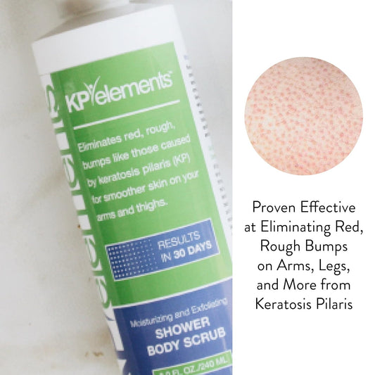 Kp Elements Body Scrub (8 Fl Oz) | Keratosis Pilaris Treatment | Exfoliating Body Scrub And Body Moisturizer For Dry Skin | Helps Reduce Red Bumps | Body Skin Care Product For Men And Women