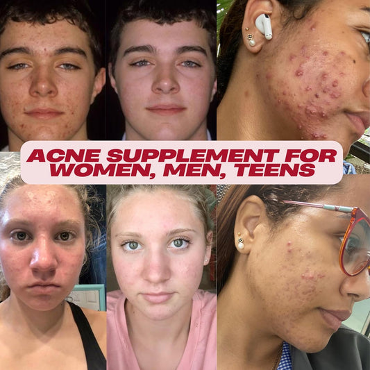 Acne Pills- Vitamin Supplements For Acne Treatment- Natural Clear Skin From Hormonal Cystic Pimples- Oily Skin Vitamins Pill For Women, Teen, Men, & Adults 60 Tablets