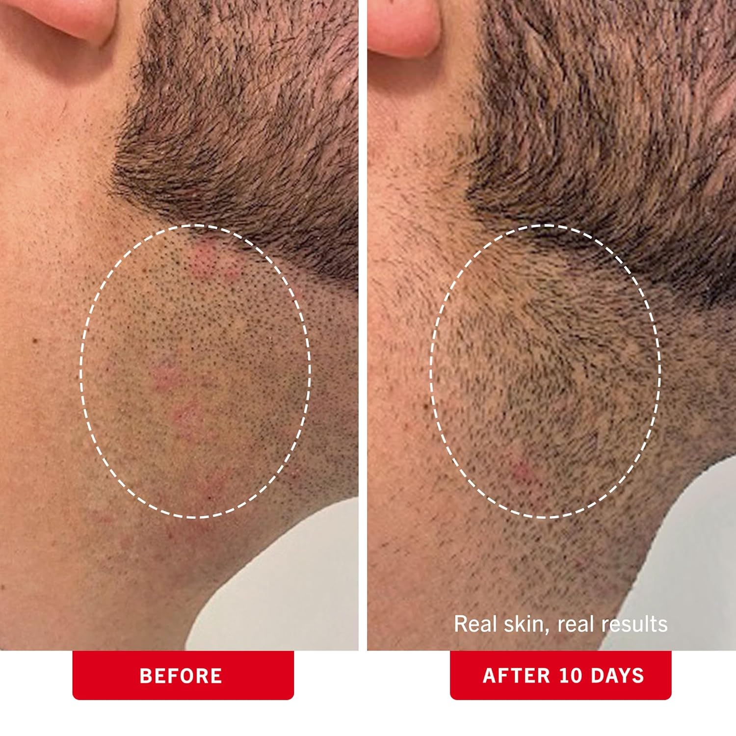 First Aid Beauty - Ingrown Hair Pads With Bha + Aha - Aftershave Treatment Pads To Help Prevent Razor Bumps For Men & Women - Exfoliate Underarms & Bikini Area - Compostable For Daily Use - 60 Pads : Beauty & Personal Care