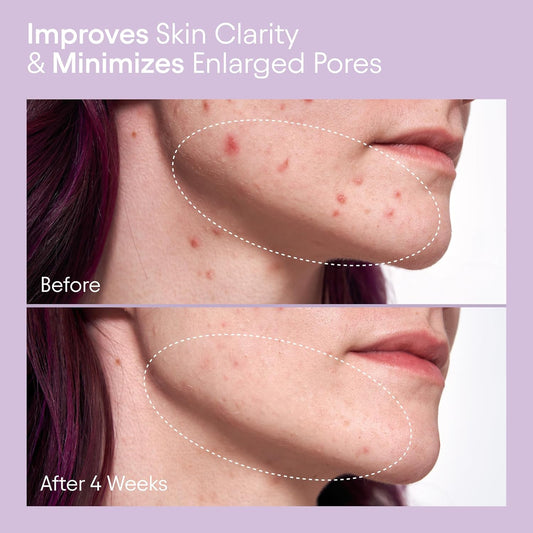 Alpyn Pore Perfecting Liquid Toner With 2% Bha & Borage | Liquid Exfoliator To Minimize Pores, Calm & Restore Skin'S Natural Ph | 4 Oz / 120 Ml