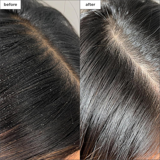 Briogeo Scalp Revival Buildup Detox Spray, Dry Scalp Pre-Wash Treatment For Dry Scalp & Itchy Scalp, Build Up, Detox Spray, 120Ml