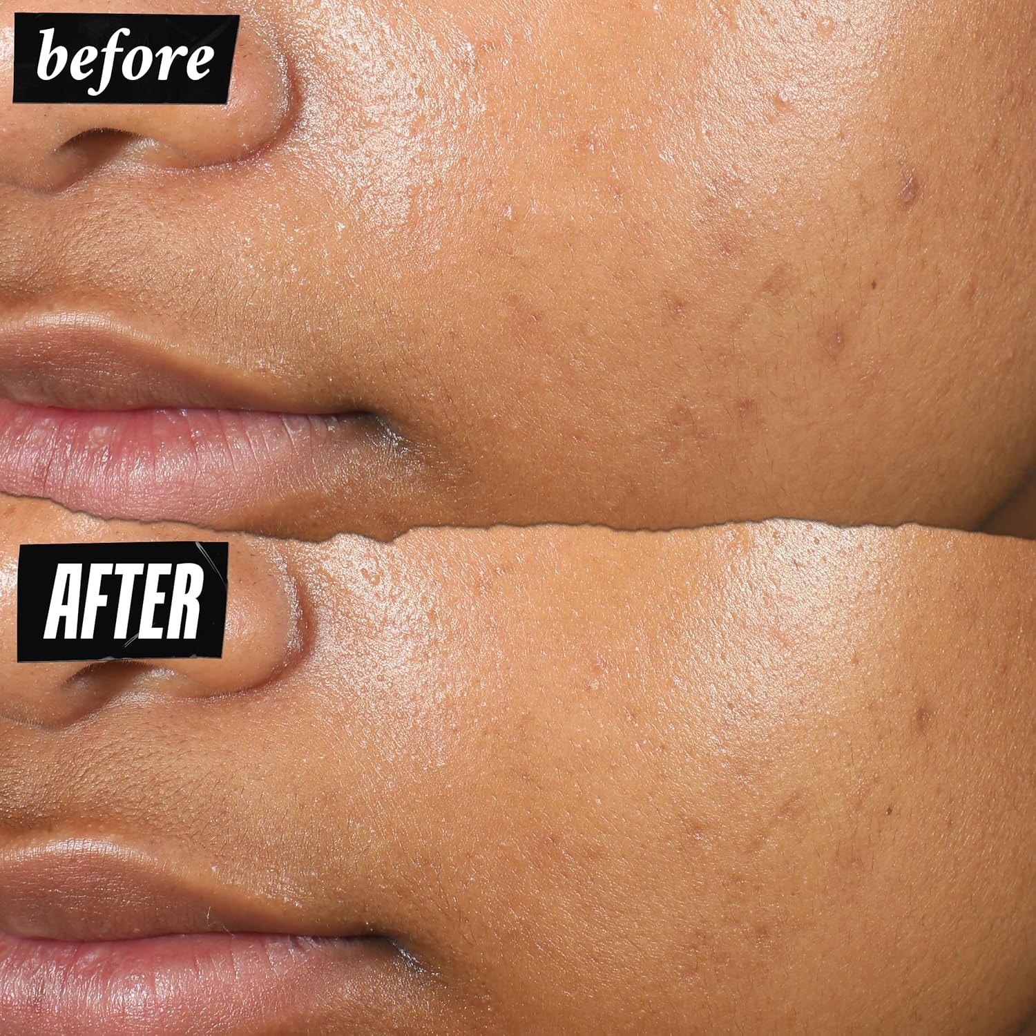 Kiehl'S Truly Targeted Acne-Clearing Pimple Patch With 2% Salicylic Acid, Invisible Liquid Spot Treatment, 4% Niacinamide Fades Post-Acne Marks, 0.2% Licorice Root Soothes Redness - 0.5 Fl Oz : Beauty & Personal Care