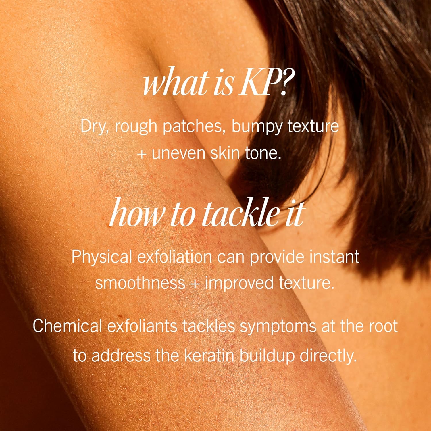 First Aid Beauty - Kp Bump Eraser Body Scrub With 10% Aha, Keratosis Pilaris Skin Exfoliator With Glycolic And Lactic Acids, Helps Reduce Chicken Skin Bumps, Safe For Sensitive Skin, 8 Oz