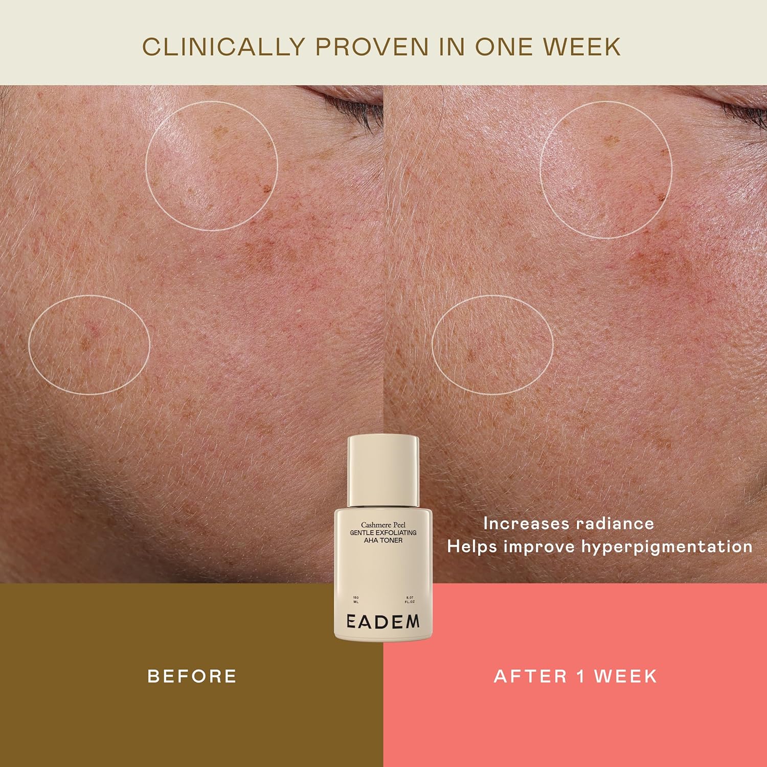 Eadem Gentle Exfoliating Aha & Pha Toner, Exfoliating Face Serum With Tranexamic Acid, Aha Exfoliant & Pore Minimizer For Face And Body, Acne Spot Serum, 5.0 Oz, Cashmere Peel : Beauty & Personal Care