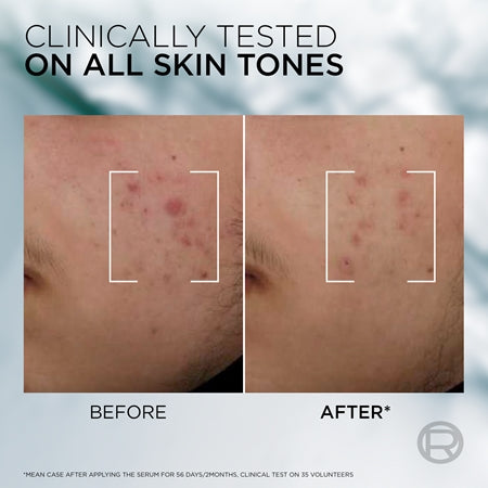 L’Oréal Paris Men Expert Derma Control Serum To Treat Skin Imperfections 
