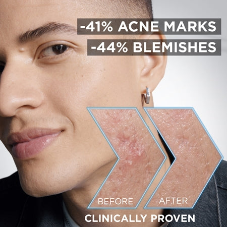 Garnier Pure Active Charcoal Serum To Treat Skin Imperfections