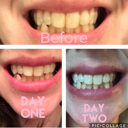 Dr Song Teeth Whitening Kit 3X Syringes 35% Carbamide Peroxide, Light, Trays