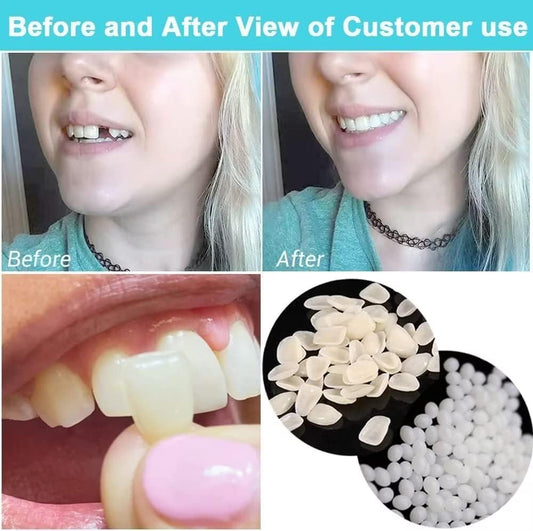 Temporary Tooth Repair Kits for Filling The Missing Broken Tooth and Gaps-Moldable Fake Teeth and Thermal Beads Replacement Kits