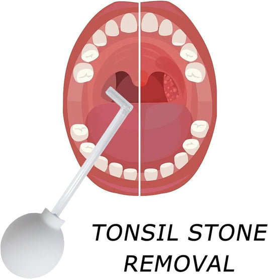 Tonsil Stone Remove Tool Manual Style Cleaner Removal Mouth Cleaning Oral Care Mouth Cleaner for Adults?White?