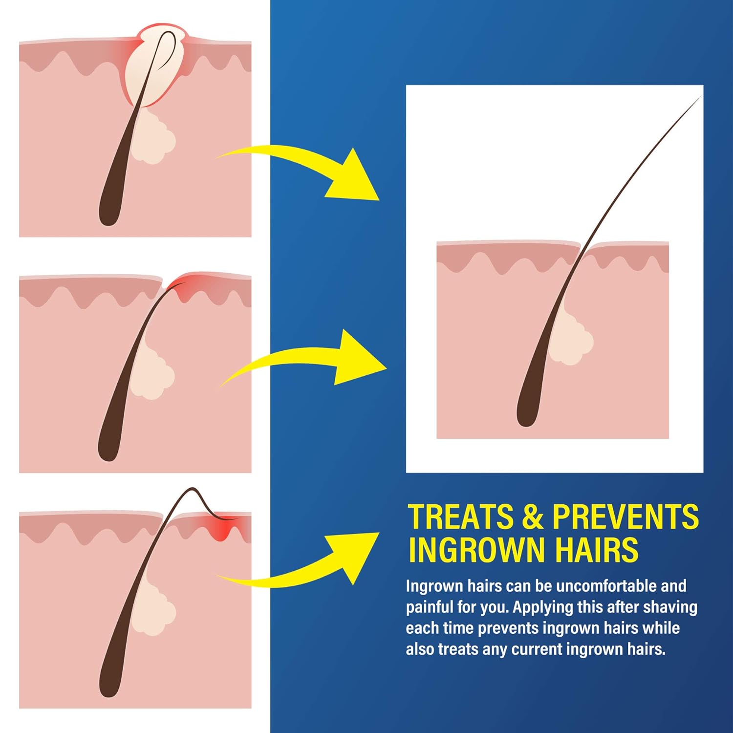 Esupli.com Razor Bump and Ingrown Hairs Serum - After Shave Solution Ro