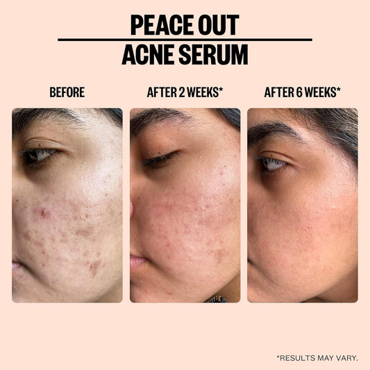 Peace Out Skincare Acne Serum | Daily Multi-Benefit Face Serum with 2% Salicylic Acid to Target Pimples, Zits, Blemishes and Breakouts | For Clearer-Looking Skin (1  )